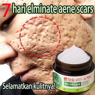 Bekas Jerawat Krim alat jerawat dan bekas jerawat 30g Rumus herbal mengecilkan pori pori wajah/ jerawat/komedo/pemutih kuli