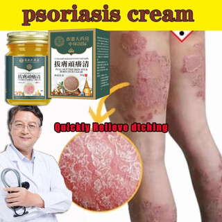 Krim Psoriasis Krim Antijamur Krim Eksim Salep Kulit Serbaguna – Gatal, Jamur & Psoriasis Hilang 3 Hari!