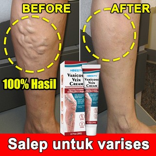 【100% Asli】Obat Varises Varicose Veins Cream Penghilang Varises, Obat Varises Original Obat Varises Di Kaki Dan Betis Paling Ampuh, Salep Laba-Laba Vaskulitis Flebitis Pengobatan Vaskulitis Salep Flebitis Salep Laba-Laba 20g