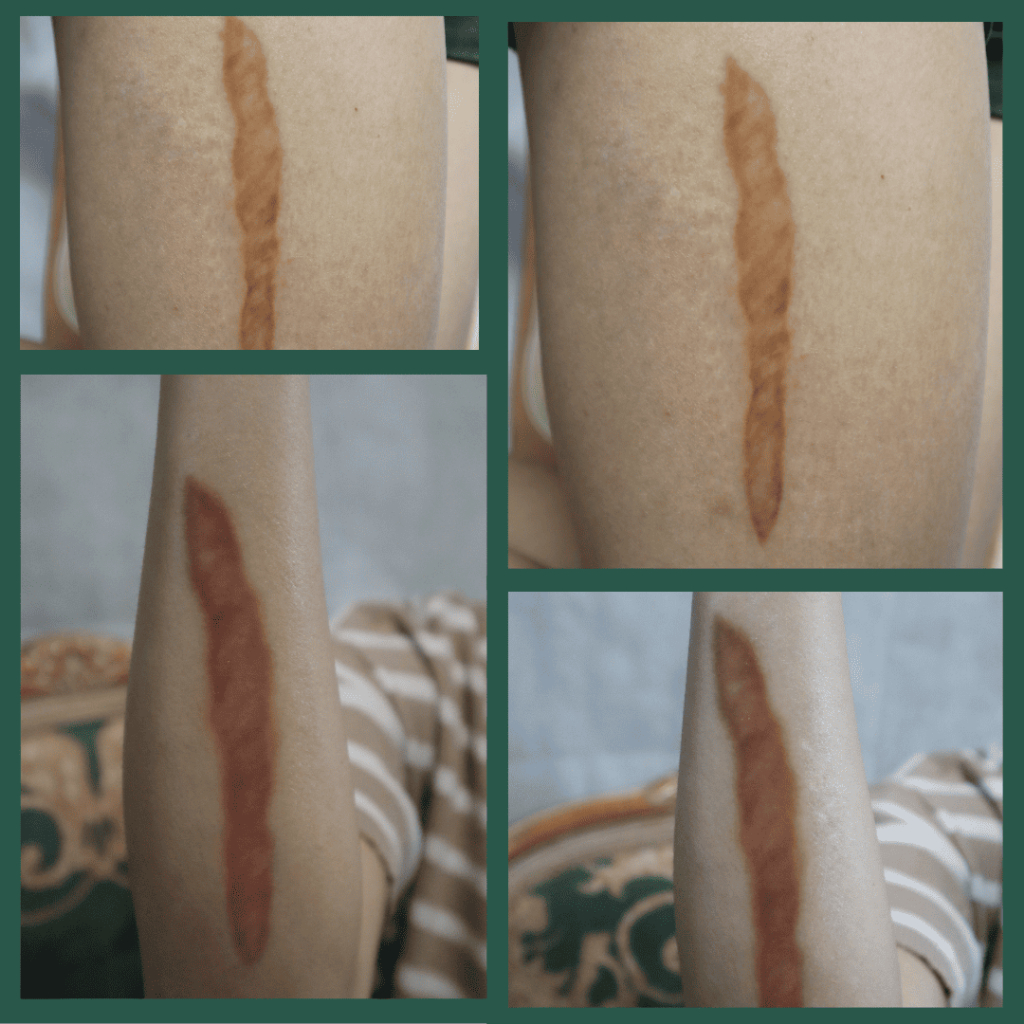 LOKAL [ผลิตภัณฑ์ท้องถิ่น] BUNDLING TEMPORARY TATTOO HEALED MEDIUM & OLD MEDIUM KELOID | PRAKS | คอสเ