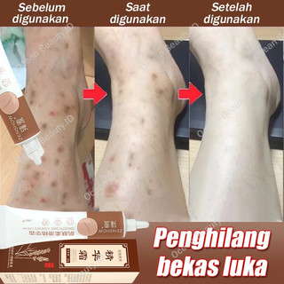 Penghilang bekas luka hitam koreng Penghilang bekas luka di kaki Scar remover cream Penghilang Bekas cacar Bekas gigitan nyamuk Menghilangkan bekas jerawat