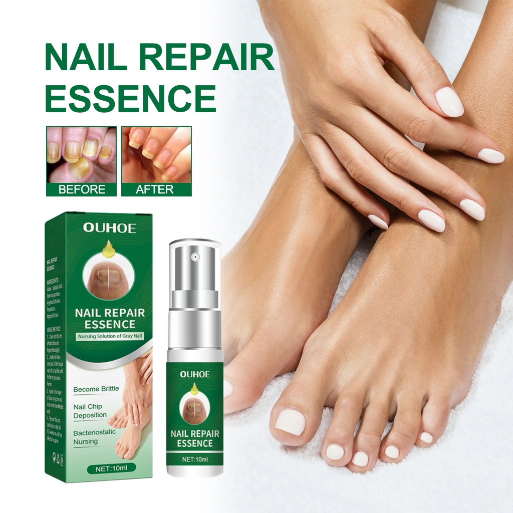 OUHOE Nail Repair Essence Nail สําหรับเล็บเท้าที่นุ่มนวลสีเหลืองหนาหรือคุด Nail Strengthener