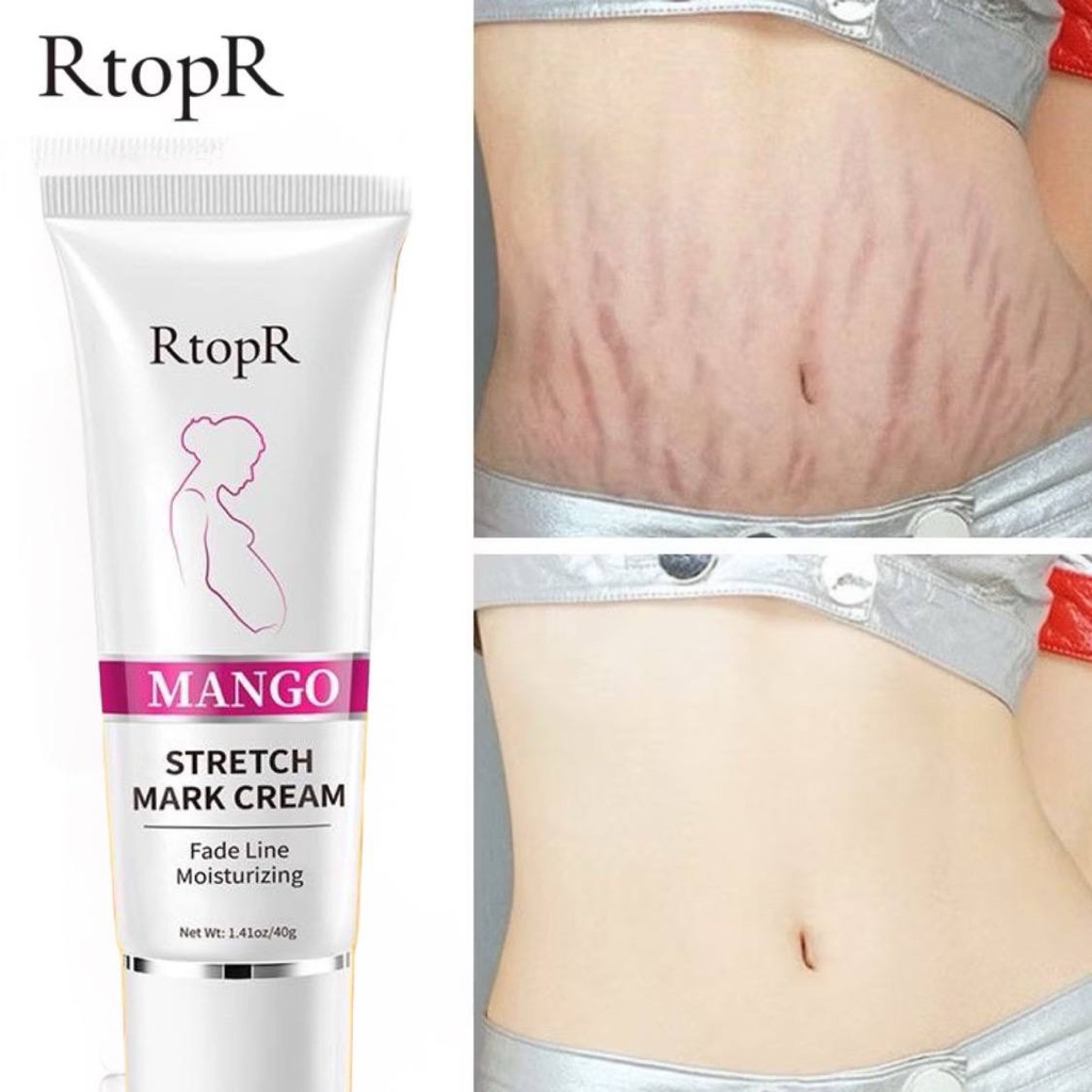 RTOPR MANGO STRETCH MARK CREAM รอยแตกลายผิว ขจัดเส้นสีดํา