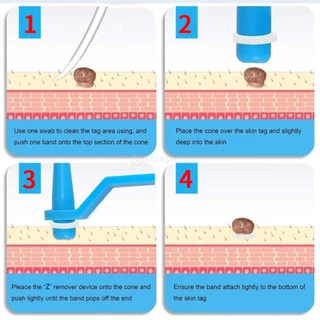 อุปกรณ์กำจัดหูด ไฝ ติ่งเนื้อ หลุดออกอย่างง่ายดาย Medical Skin Tag Kill Remover