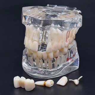 Implant Dental Disease Teeth Model With Restoration Bridge Tooth For Medical Science Dental Disease Teaching Study Tool