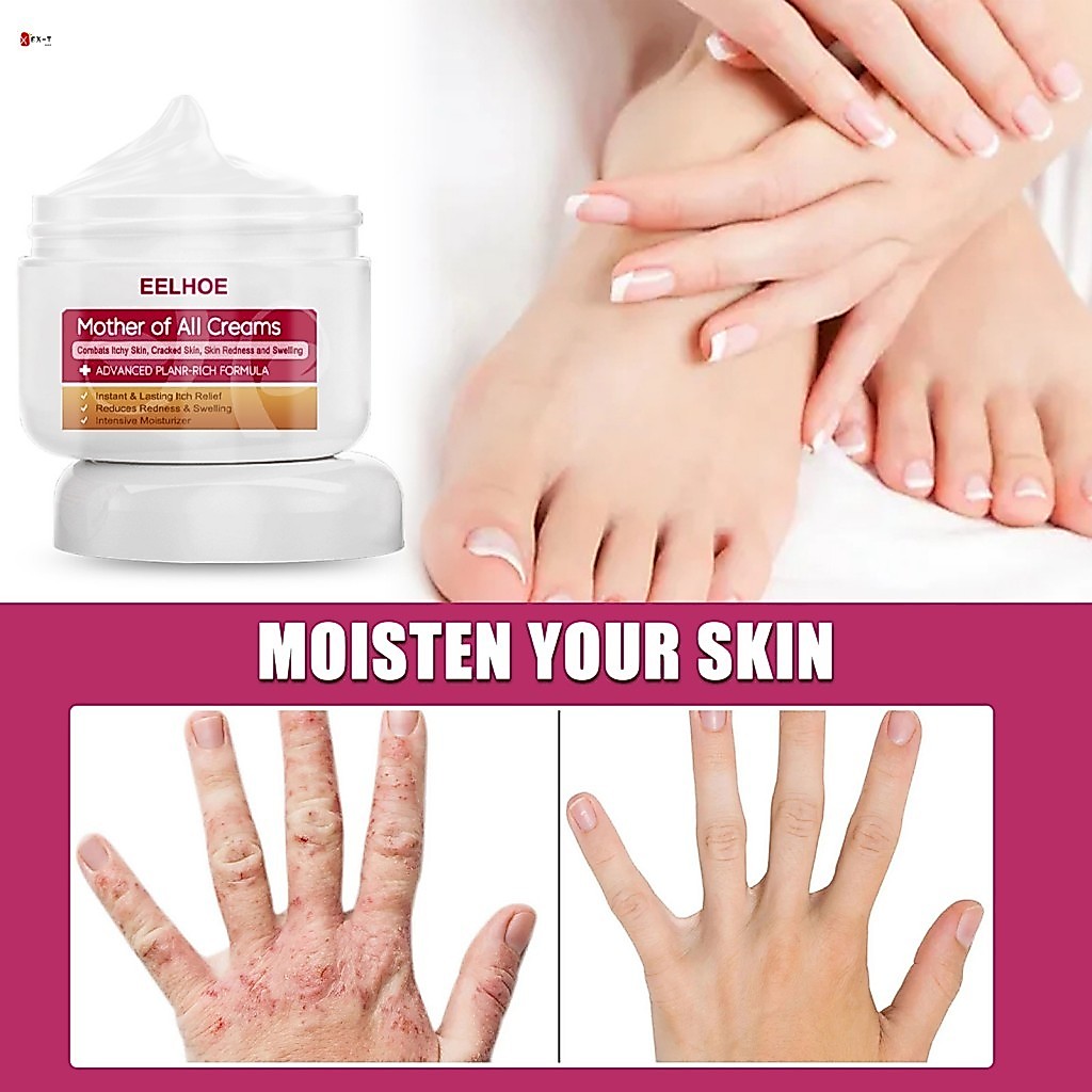 Eczema Therapy Moisturizing Cream - Acne Stretch Marks Repair Face Cream เพื่อผิวสุขภาพดี