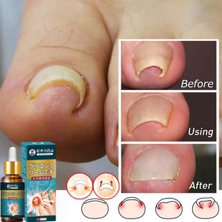 Ingrown toenail treatment toenail fungus treatment nail fungus treatment Treats swelling and pain