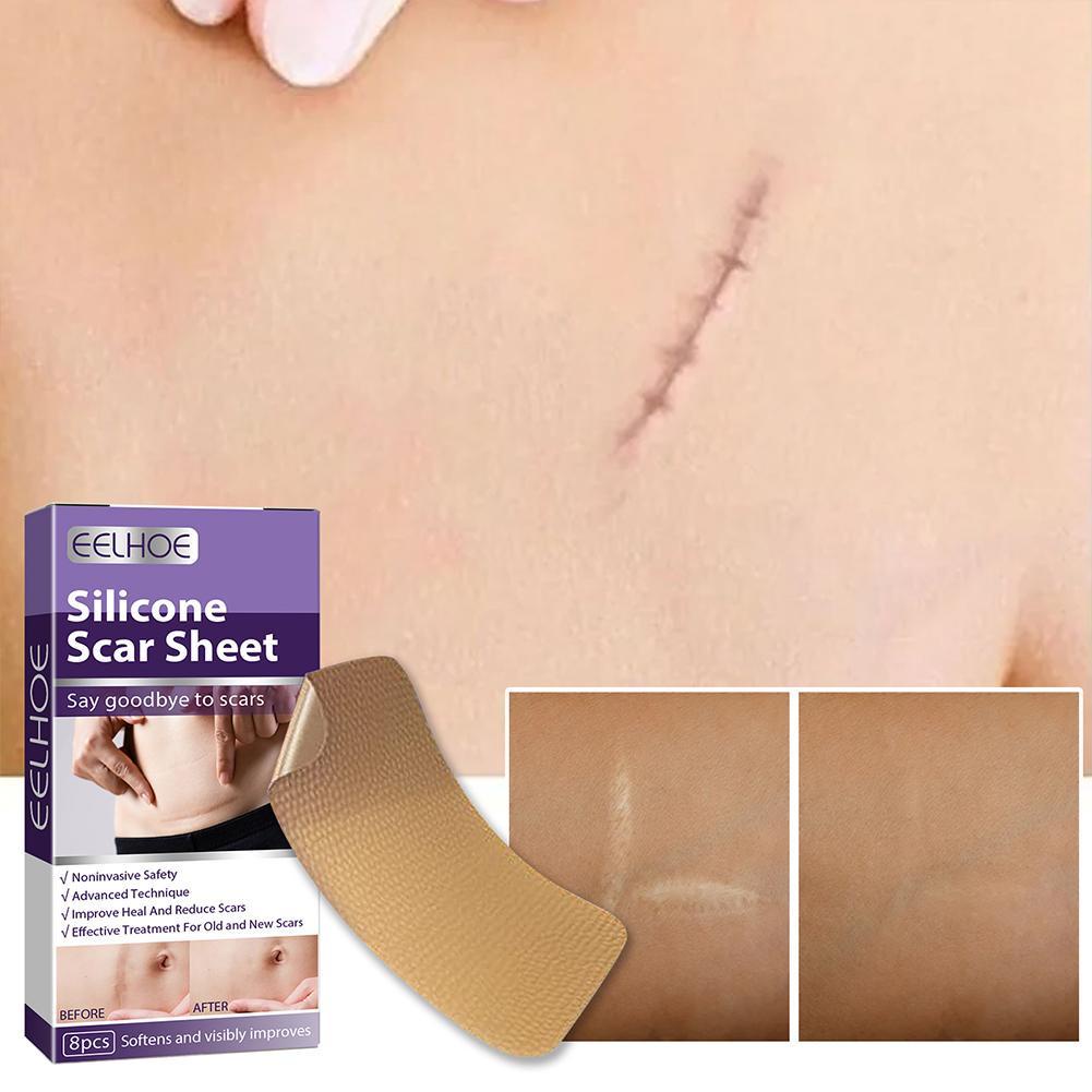 สติกเกอร์ซิลิโคนเจล รูปแผลเป็น ลดรอยแผลเป็น มองไม่เห็น สําหรับ Hyperplasia I7T6