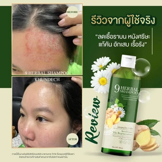 2แถม1 แชมพูโรคผิวหนัง เชื้อราบนหนังศรีษะ รังแค ลอกเป็นขลุย เชื้อรา ชันตุ กลากเกลื้อน ขุนเดช หัวลอก