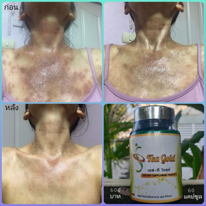 เอสทีโกลด์/ S Tea Gold  ระบบน้ำเหลือง ภูมิต้านทาน ผิวหนัง สะเก็ดเงิน ผิวพรรณสดใส