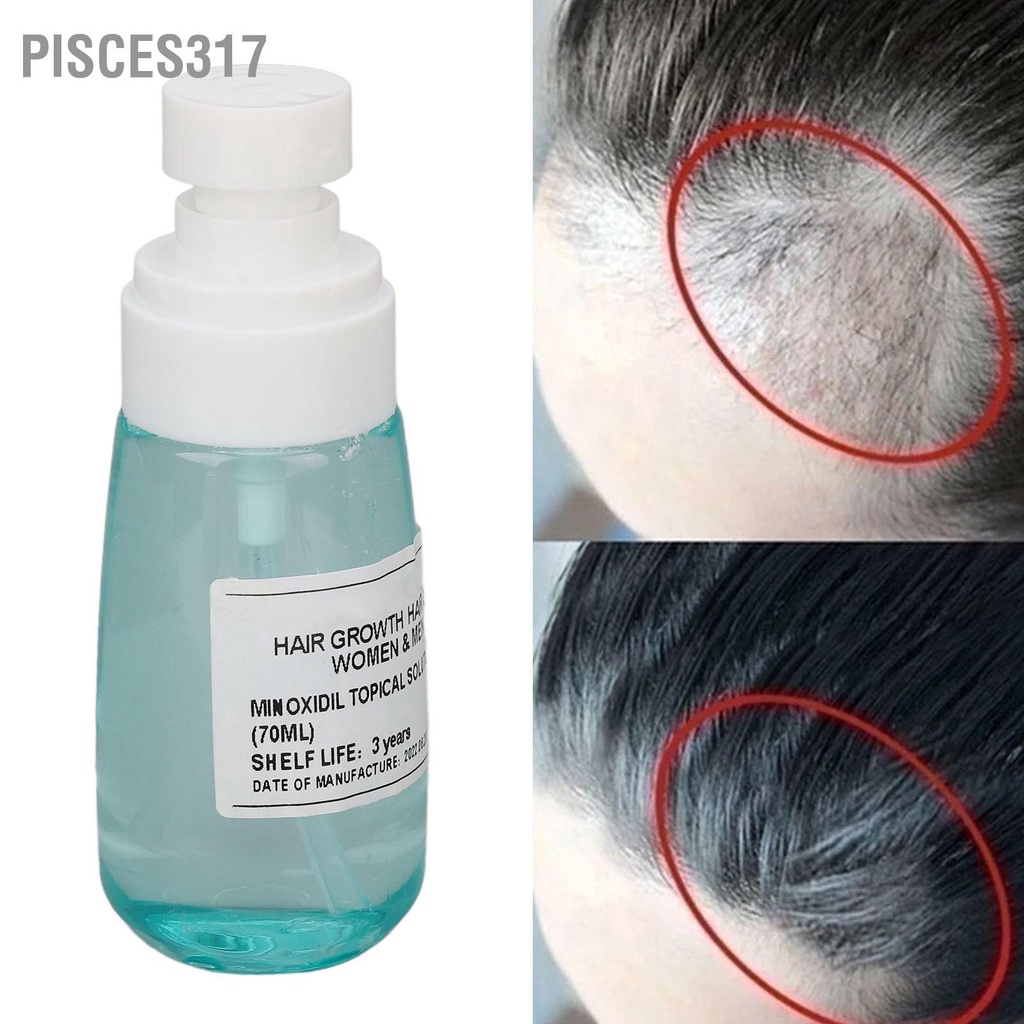 Pisces317 Minoxidil Hair Growth Spray 70ml Fast Plants Extract Scalp Repair Texture for Beard Chest