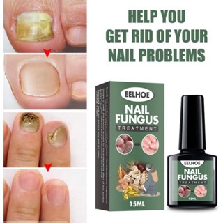 Eelhoe nail fungus น้ำยาบำรุงเล็บกำจัดเชื้อราที่เล็บ