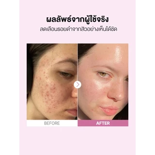 COSRX The Niacinamide 15 Serum 20ml เซรั่มไนอะซินาไมด์สูตรเข้มข้นที่ผสานส่วนผสมจัดการสิวอย่างลงตัว จากคอสอาร์เอ็กซ์