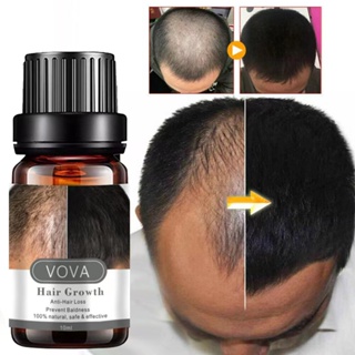 การเจริญเติบโตของเส้นผม 10ml Hair Growth 10ml