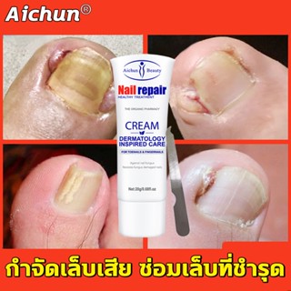 Aichun ยาฆ่าเชื้อราที่เล็บ ต่อต้านการติตเชื้อรา ซ่อมแซมเล็บแตก เล็บเปราะ เชื้อราเล็บ ยาทาเชื้อราเล็บ ยาฆ่าเชื้อราเล็บ20g