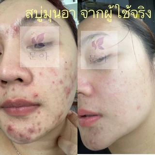 🔥สบู่เคลียร์สิวอุดตัน บำรุงผิวนุ่ม สูตรอ่อนโยน
