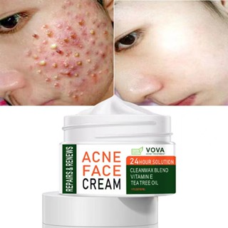 รีมแต้มสิว 30ml Cream acne D-30 ml