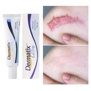 แท้ 100% Dermatix Ultra / Acne เดอร์มาติก เดอร์มาติกซ์ ลดรอยแผลเป็นนูน แผลคีลอยด์