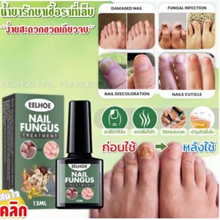 ***พร้อมส่ง**Eelhoe nail fungus น้ำยาบำรุงเล็บกำจัดเชื้อราซ่อมแซมและปกป้องเล็บรักษาจุดเหลืองเล็บขบ