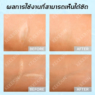 【ลบรอยแผลเป็น】South Moon แผ่นแปะแผลเป็น แผ่นซิลิโคนเจล แผ่นปิดรอยแผลเป็น ลบรอยแผลเป็นแผลผ่าตัด ลดรอยแผลเป็นนูน
