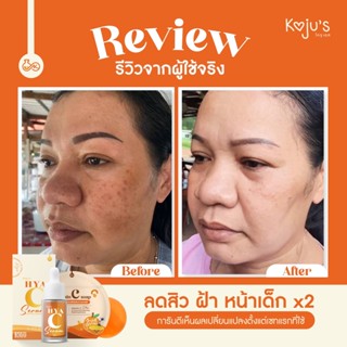 [ส่งฟรี เซต 10 ขวด] เซรั่ม KOJUS ไฮยาซีเซรั่ม เซรั่มไฮยาซี เซรั่มวิตามินซีไฮยา ไฮยาซี ไฮยาซีเซรั่มน้ำแตก  เซรั่มโคจูเอส