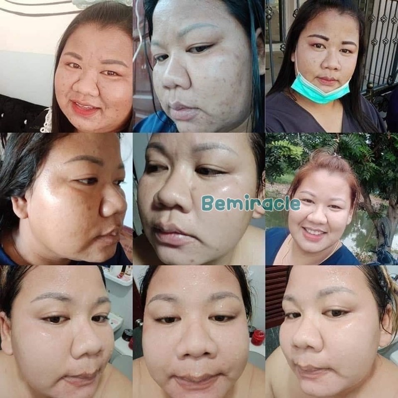ครีมบีมิราเคิล (Bemiracle cream) ครีมเขียวรักษาสิวทุกชนิด ลดรอยด่างดำ หน้าขาวกระจ่างใส ราคา ถูกที่สุด ดีลบีเคเค แกลเลอรีภาพที่ 7