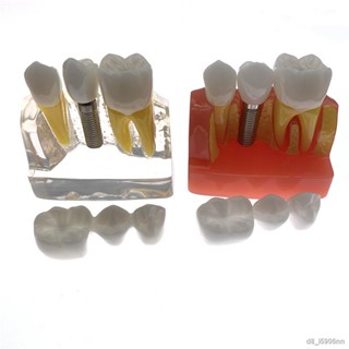 Dental 4 Times Planting Teeth Model Analysis Crown Bridge Removable Model Dental Demonstration Teeth Model - Dental Teac