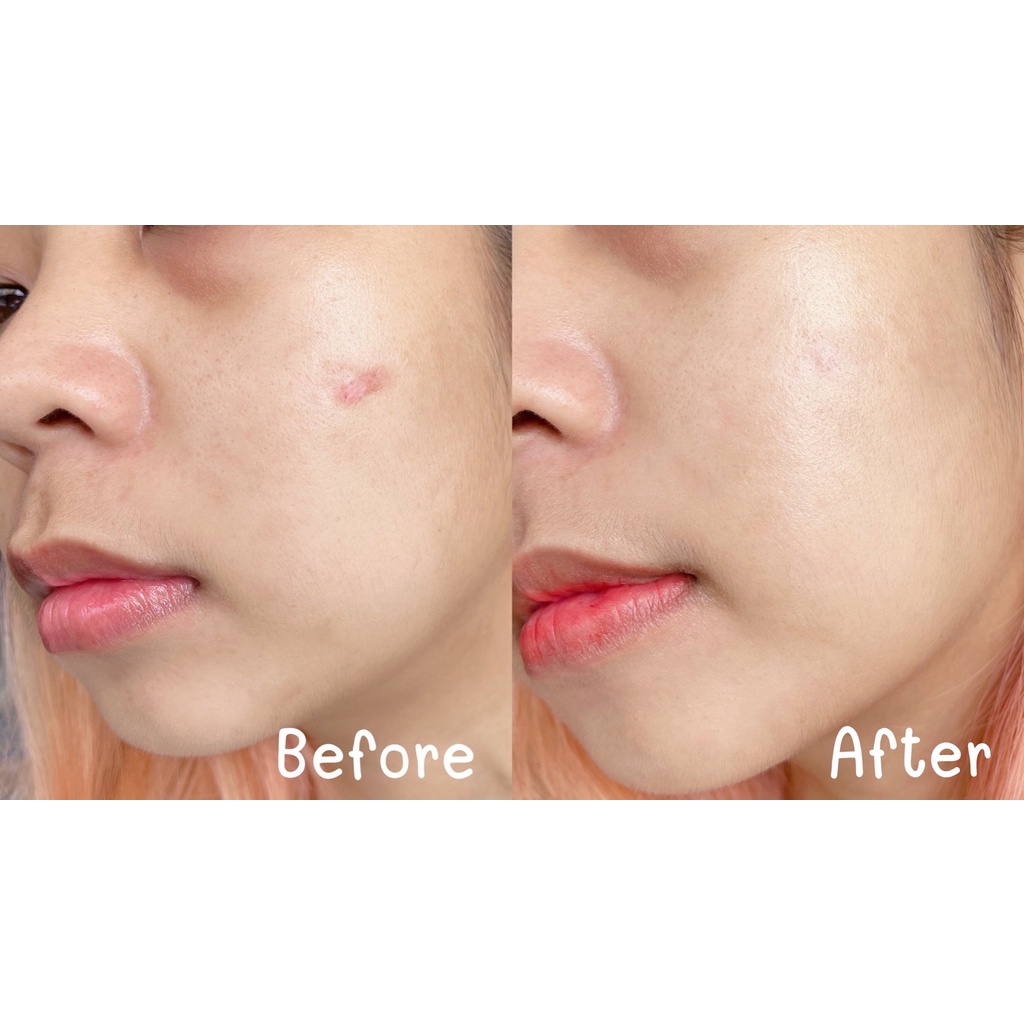 อินน์ บิวตี้ สการ์ เซรั่ม INN BEAUTY SCAR SERUM (BOX) ราคา ถูกที่สุด ดีลบีเคเค แกลเลอรีภาพที่ 3