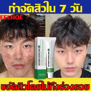 เห็นผลภายใน 7 ครีมกำจัดสิว 20g ลดเลือนรอยสิว ครีมแต้มสิว ครีมลดสิว ครีมรักษาสิว รักษาสิว เจลรักษาสิว สิวอักเสบ สิวอุดตัน