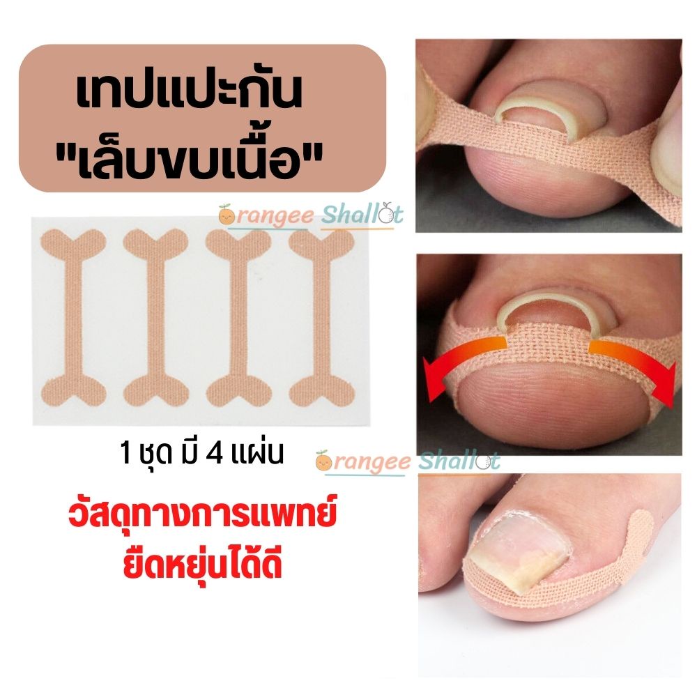 เทปแปะกันเล็บขบเนื้อ ลดอาการบาดเจ็บ จากเล็บขบ เทปพลาสเตอร์ติดกันเล็บขบ แผ่นแปะเล็บขบ เล็บฝังลึกนิ้วเท้า พร้อมส่ง F067