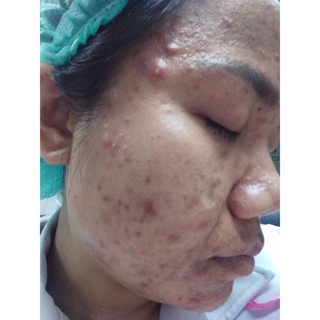 Pro Acne Cream ครีมรักษาสิว