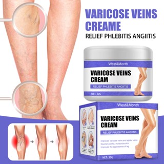 Varicose Veins Remover Treatment Cream Spider Vein Pain Varicosity มีประสิทธิภาพ Varicose Healing Cream ครีมกำจัดเส้นเลื