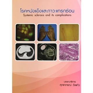 C111 9786165822404 โรคหนังแข็งและภาวะแทรกซ้อน (SYSTEMIC SCLEROSIS AND ITS COMPLICATIONS)