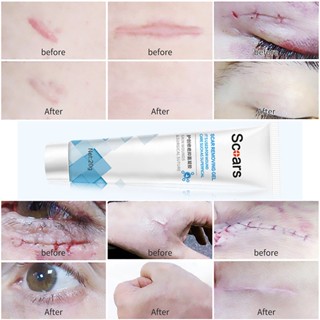 cesarean mark removal cream