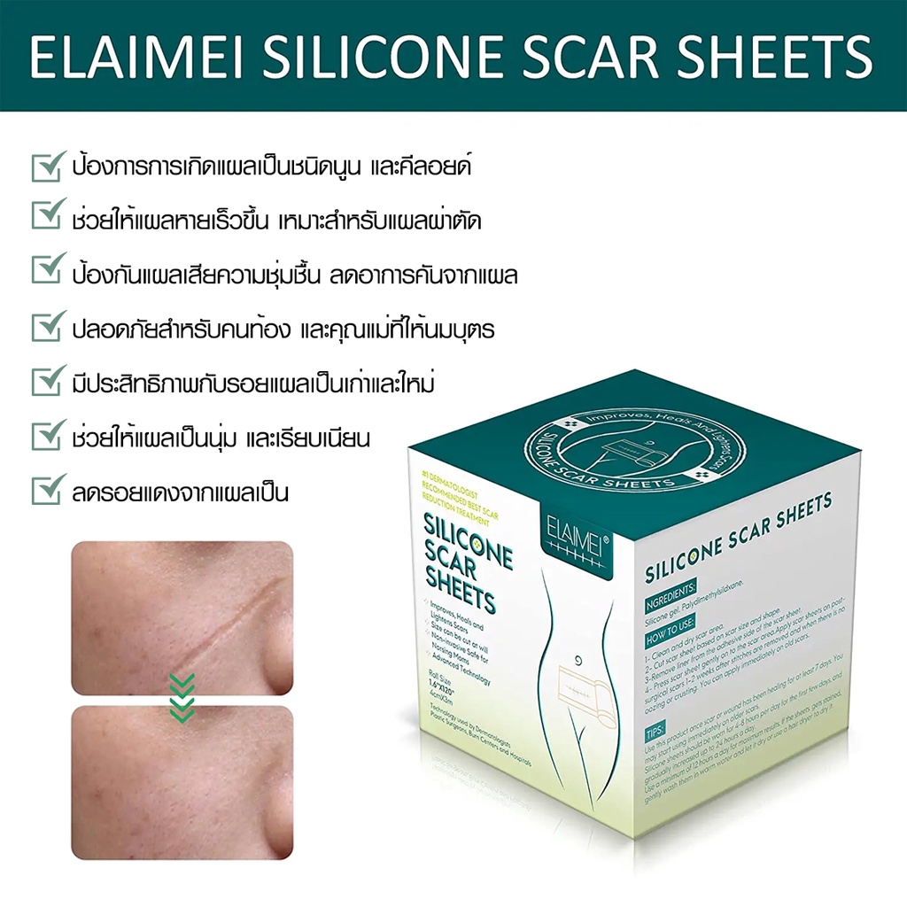 แผ่นแปะลดรอยแผลเป็นนูน แผลผ่าตัด แปะแผลผ่าคลอด  รักษารอยแผลเป็น สินค้าได้รับการรับรองมาตราฐานจากนวัตกรรม IRELAND - รูปที่ 2