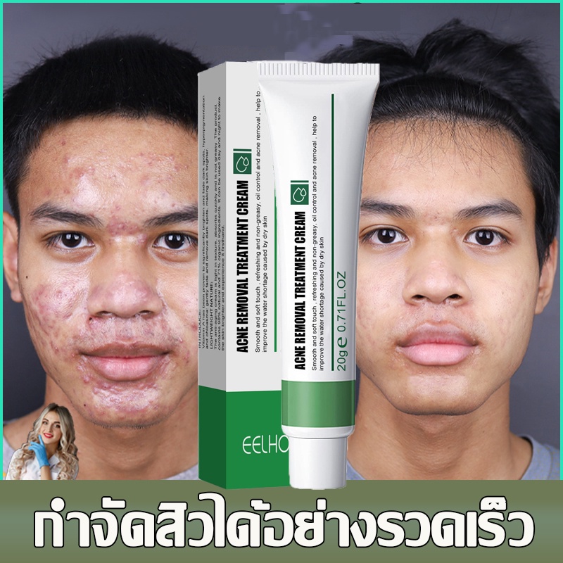 7วัน เห็นผล ครีมลดสิว ลดเลือนรอยสิว ลดสิวถาวร ซ่อมแซมรอยสิว สิวอุดตัน ครีมแต้มสิว เจลแต้มสิว ครีมรักษาสิว รักษาสิว
