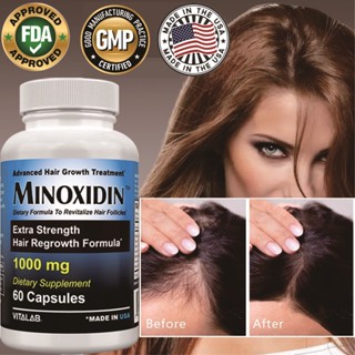 Minoxidil 5%, 1000mg Hair Growth Supplement, ส่งเสริมการงอกของเส้นผม, ป้องกันผมร่วง, 60/120 แคปซูล