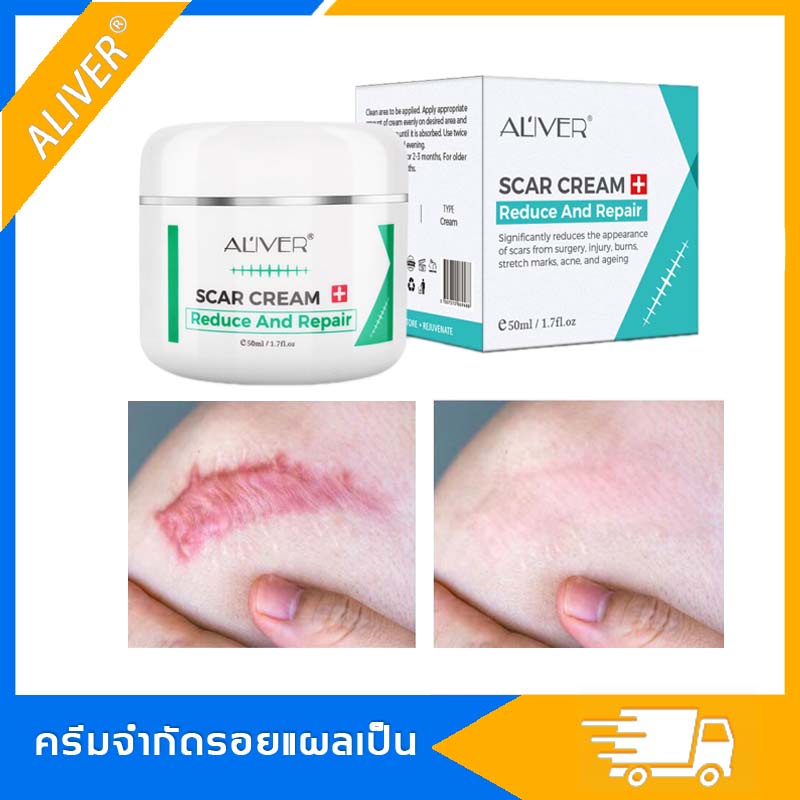 ALIVER Scar Removal Cream ครีมลดรอยแผลเป็น 50ml แผลไฟไหม้ รอยสิว รอยแตก