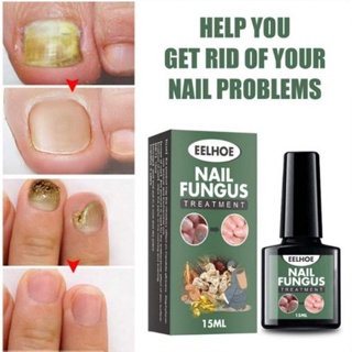 น้ำยาบำรุงเล็บกำจัดเชื้อราที่เล็บ Eelhoe nail fungus ขนาดขวดพกพา สะดวกใช้งานได้ทุกสถานที่  ขนาด 15 ml