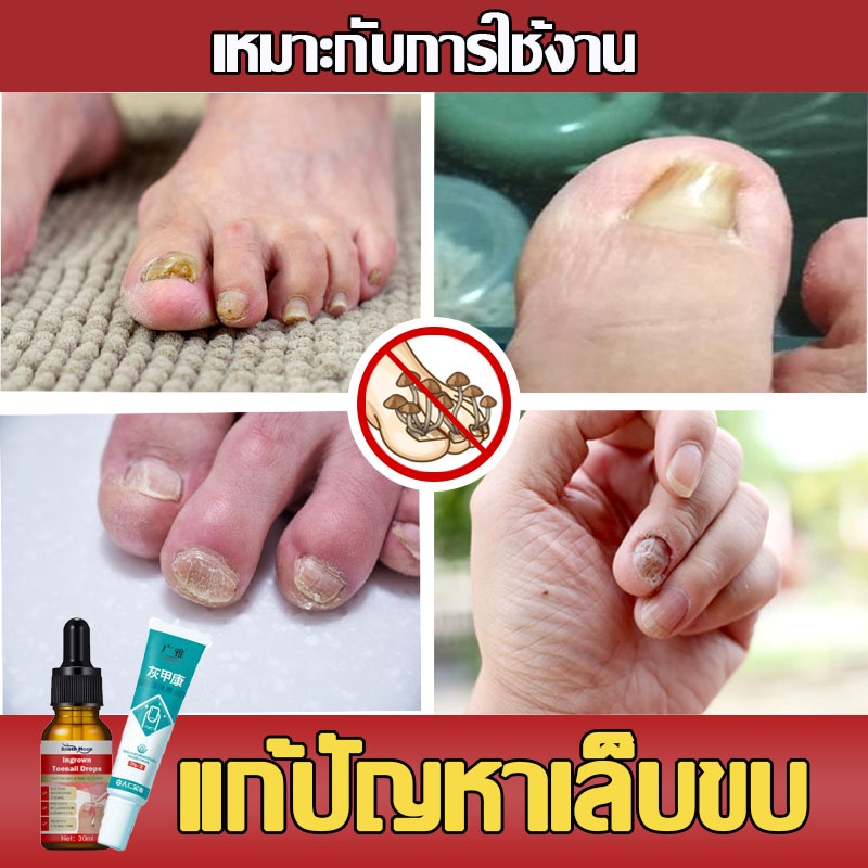 👣7วัน เห็นผล👣 ซ่อมเล็บ เซรั่มบำรุงเล็บ เล็บขบ น้ำยารักษาเล็บ เล็บแตก  ครีมซ่อมเล็บ เซรั่มรักษาเล็บ ผลิตภัณฑ์ดูแลเล็บ | Shopee Thailand