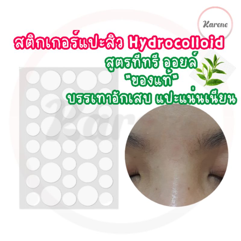 💥พร้อมส่ง💥Karene แผ่นแปะสิวHydrocolloid Tea Tree Oil ฟรี!ซองซิป ติดแน่น ยืดหยุ่น ตรงปก คละขนาด