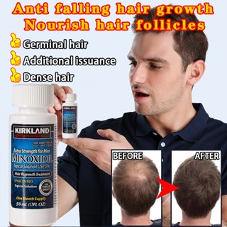 Minoxidil Topical Solution Hair Regrowth Treatment 5% ป้องกันผมร่วงส่งเสริมการเจริญเติบโตของเส้นผม 60ml (ฟรี Dropper)