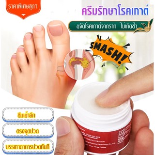 ครีมรักษาโรคเกาต์ ครีมแก้ปวด