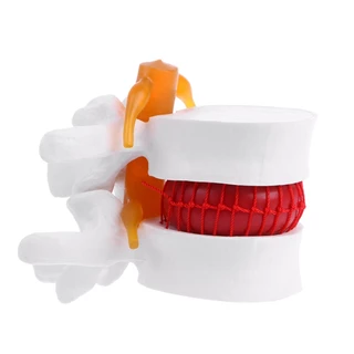 กายวิภาคของมนุษย์ Lumbar Disc Herniation Model การแพทย์ เรียนรู้ Aid Anatomy Instrume