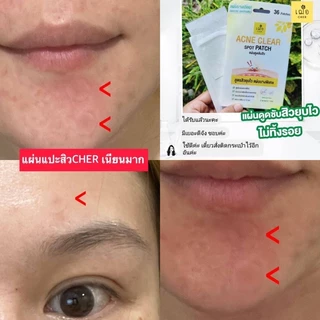 CHER Acne Clear Spot Patch เฌอ แผ่นดูดซับสิว