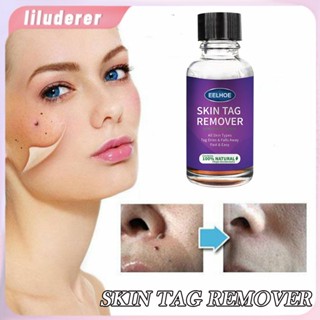 10/20/30/50Ml Mole Skin Tag Removal Solution ไม่เจ็บปวด Mole Skin Dark Spot Removal Face Wart Tag HO