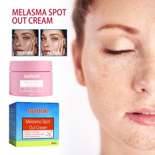 Ouhoe Melasma Spot Out Cream 30g ครีมเมลาสม่า Pekas Remover จุดด่างดํา ครีมกําจัดกระ บนใบหน้า