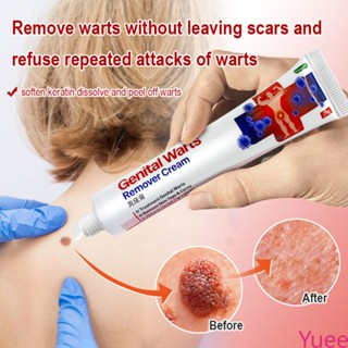 หูดอวัยวะเพศเริม Remover ครีมแท็กผิวตุ่นและ Papillomas หูด Remover Condyloma Acuminatum ครีมรักษา Yuee