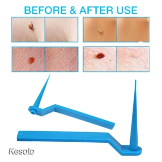 อุปกรณ์กำจัดหูด ไฝ ติ่งเนื้อ หลุดออกอย่างง่ายดาย Medical Skin Tag Kill Remover