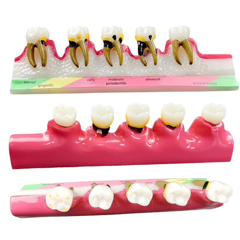 โมเดลฟัน รุ่น Caries Evolution 5 Stage Demo สําหรับทันตกรรม